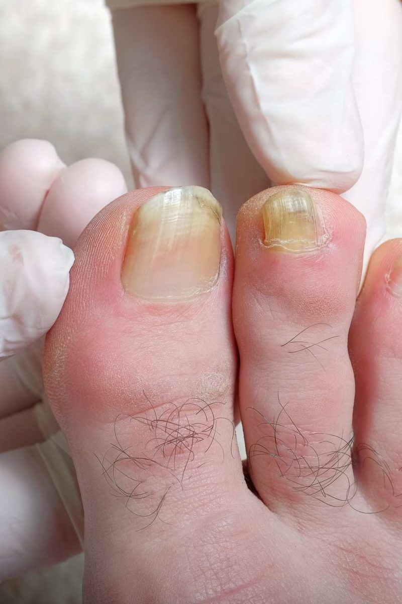 Nails turning yellow? Might not be discolouration but nail fungus-- causes  and preventive measures | Health News, Times Now