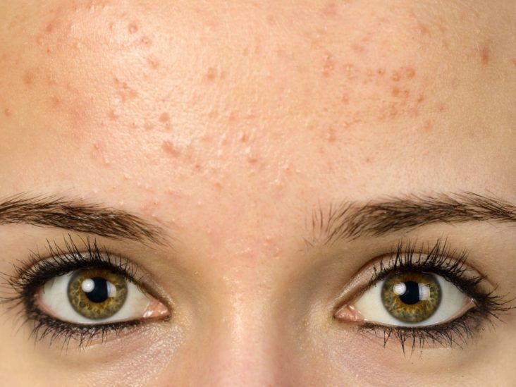 Spots on different parts of the face: Meaning & Causes