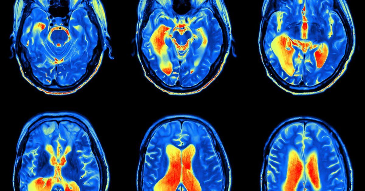 Rheumatoid arthritis: How chronic inflammation affects the brain