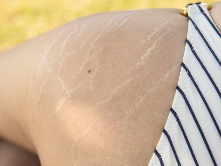 How to treat dark stretch marks on my inner thighs - Quora