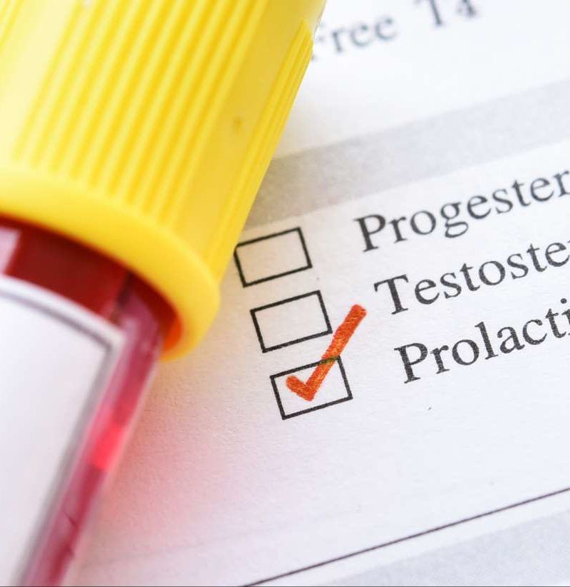 Prolactin levels Test ranges results and treatment