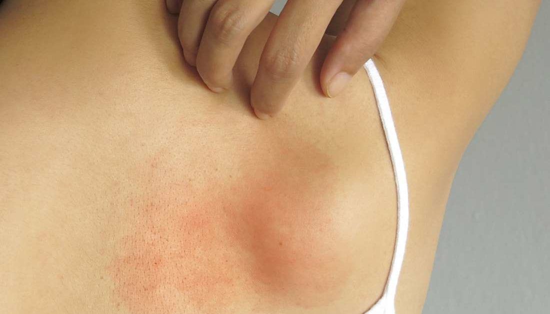 Why is my rash hot to touch?