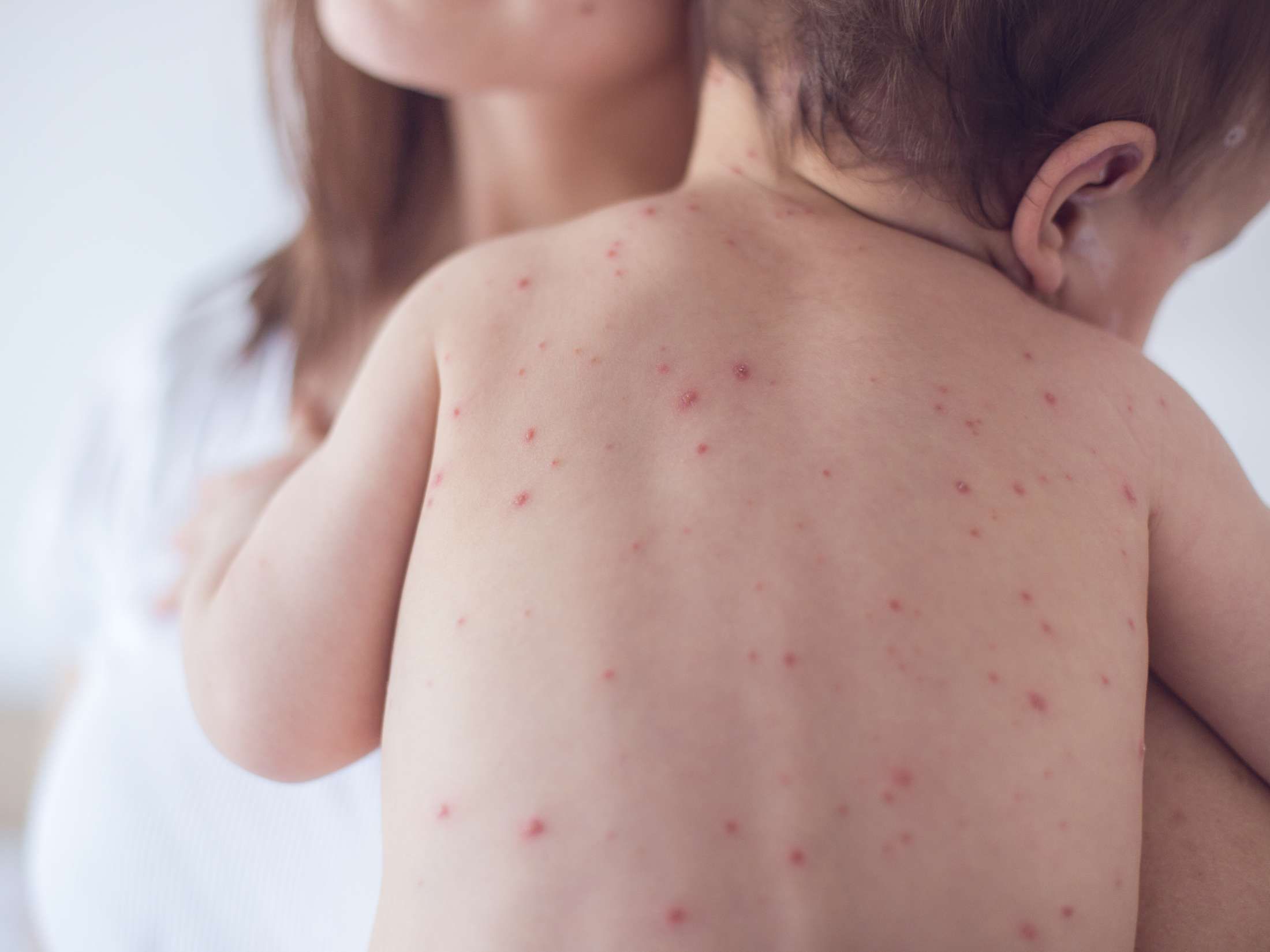 Chickenpox vs. measles: Symptoms, pictures, treatment, and more