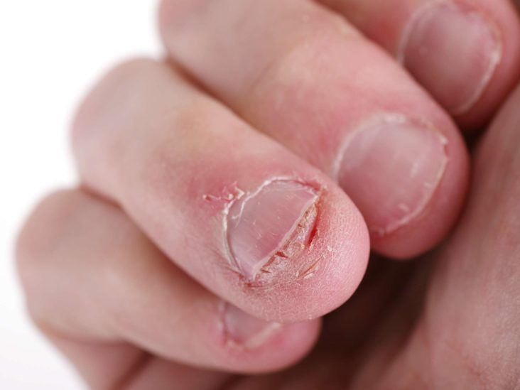 How to Treat Damaged Nail Beds After Acrylics