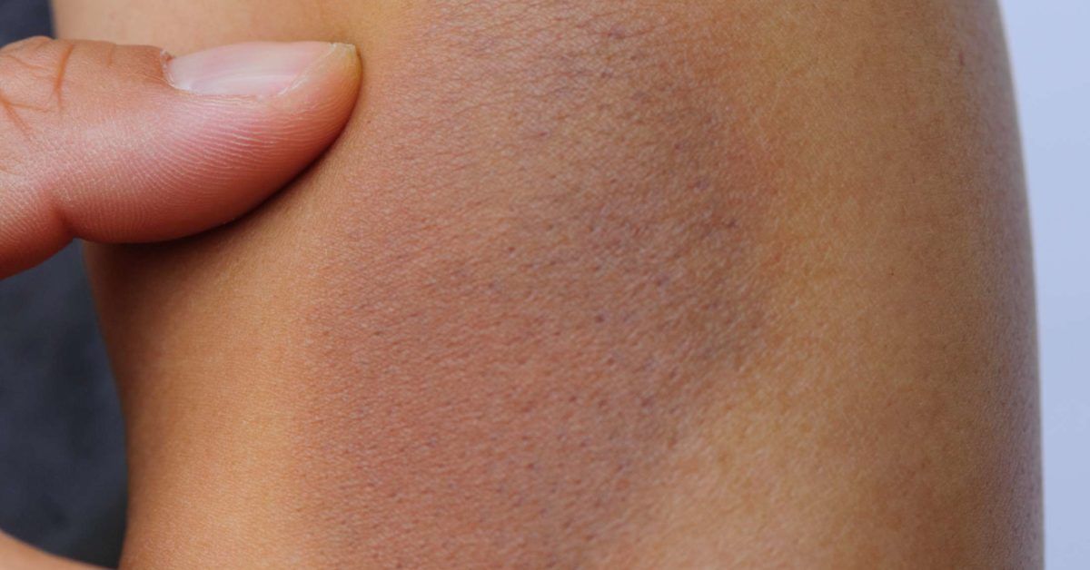 Bruise colors Stages, causes, and when to contact a doctor