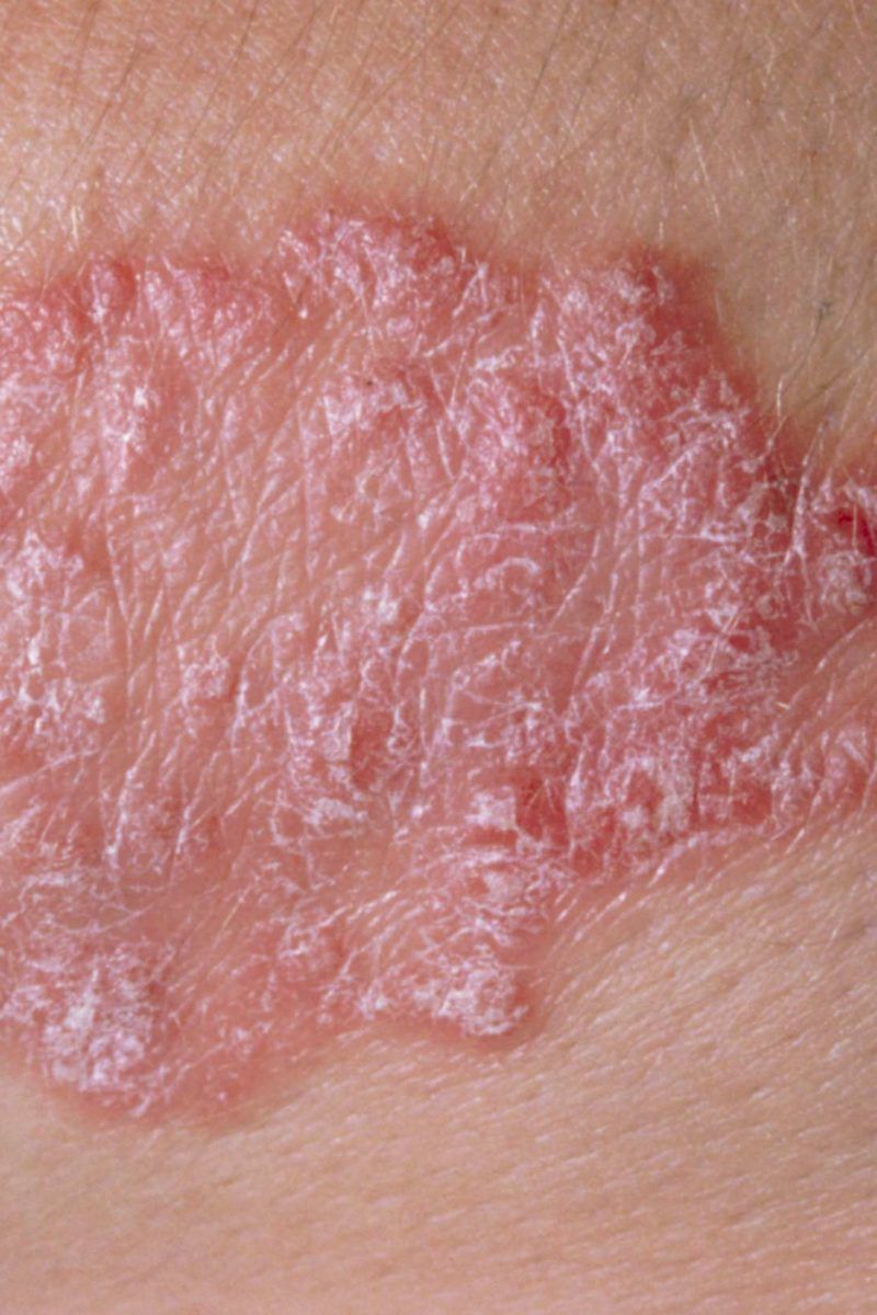 Psoriasis vs. lupus: Similarities and differences