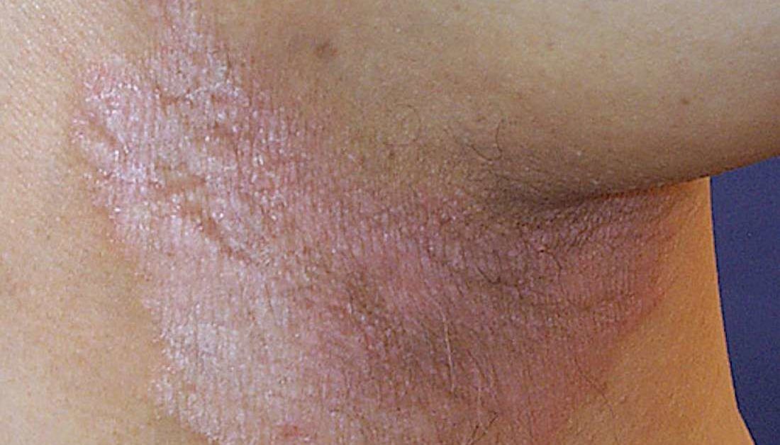 A friction burn was around the left inguinal region.