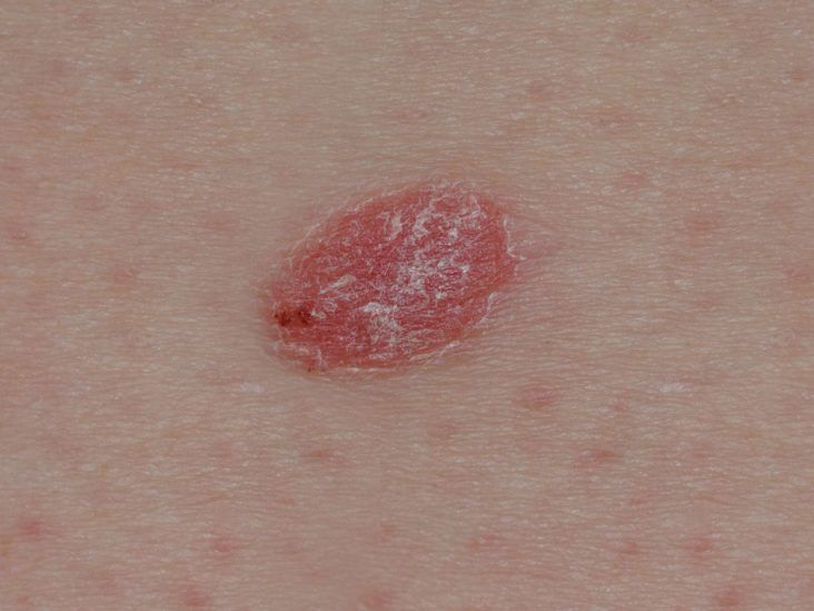 psoriasis pustulosa leve