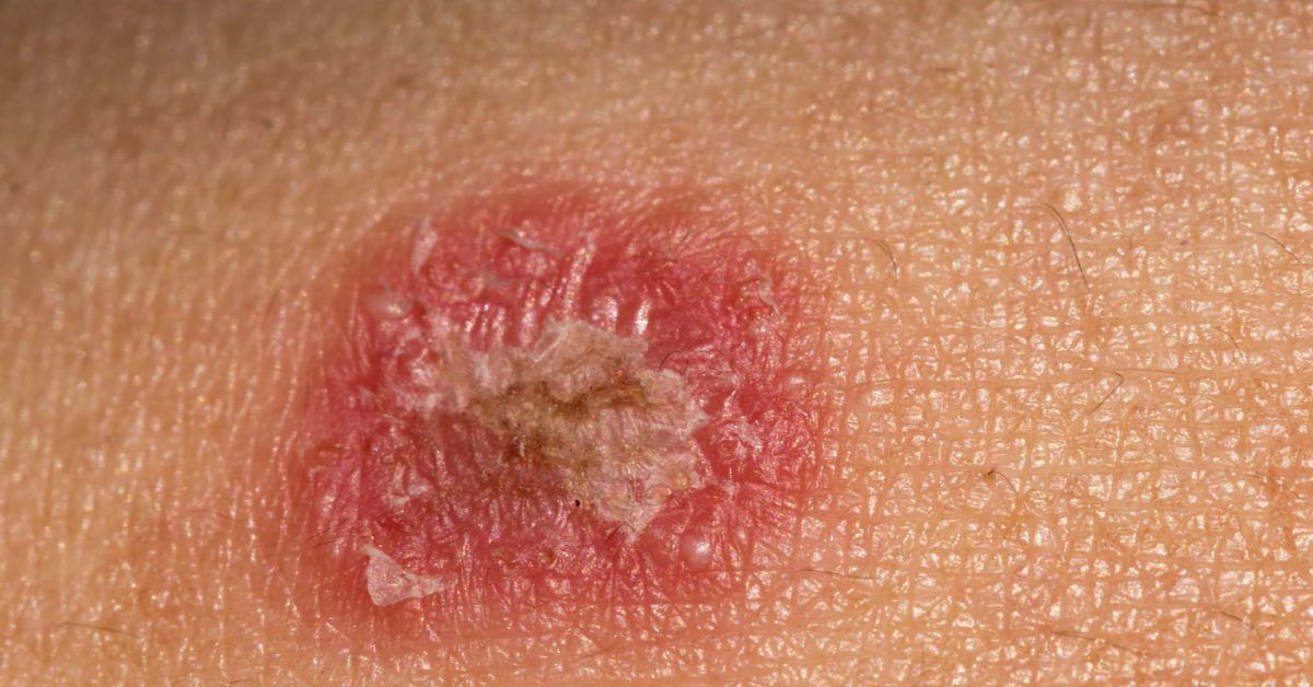 What Causes Red Spots On Skin? Guide To Treatment Types