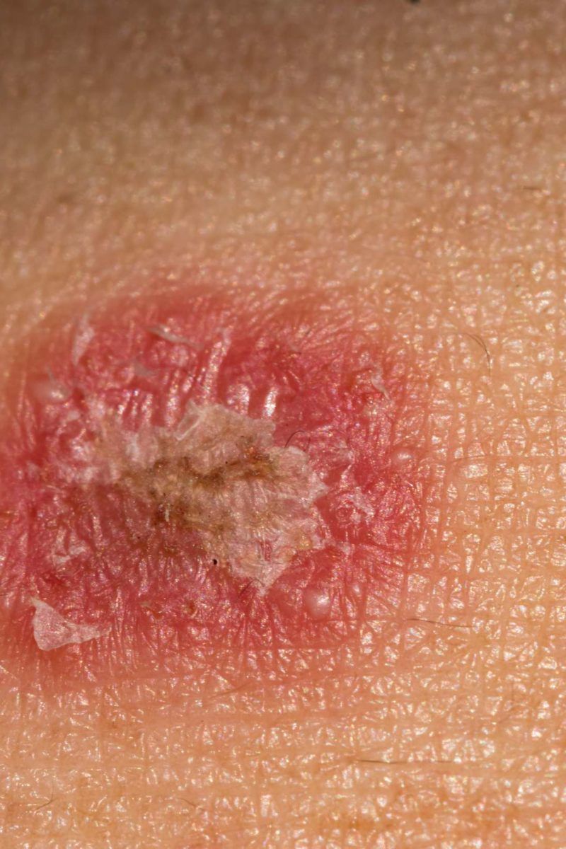 What is Ringworm? | How to Treat Ringworm | LloydsPharmacy
