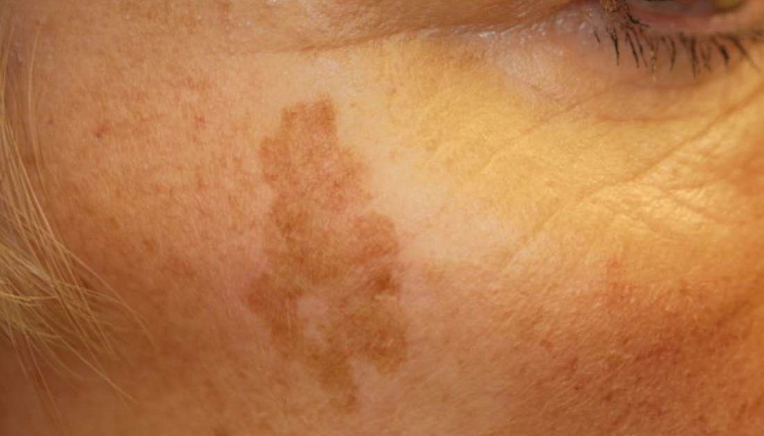 Age spots: Causes, symptoms, and treatment