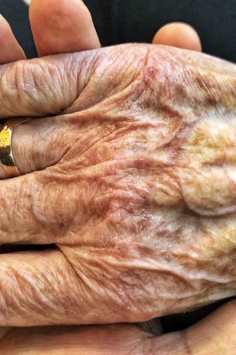 Parkinson's disease Signs and symptoms