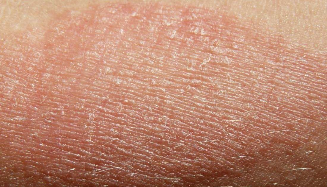 Dry skin patches Causes, symptoms, diagnosis, and treatments