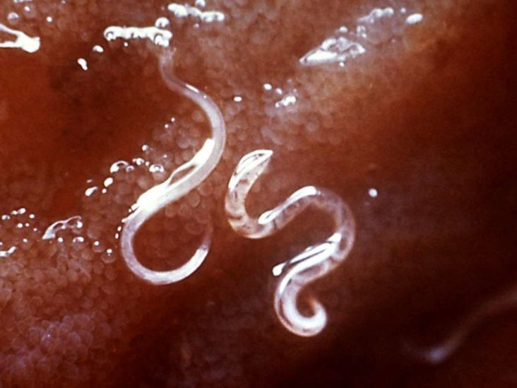 Intestinal worms: Types, causes, symptoms, and treatment