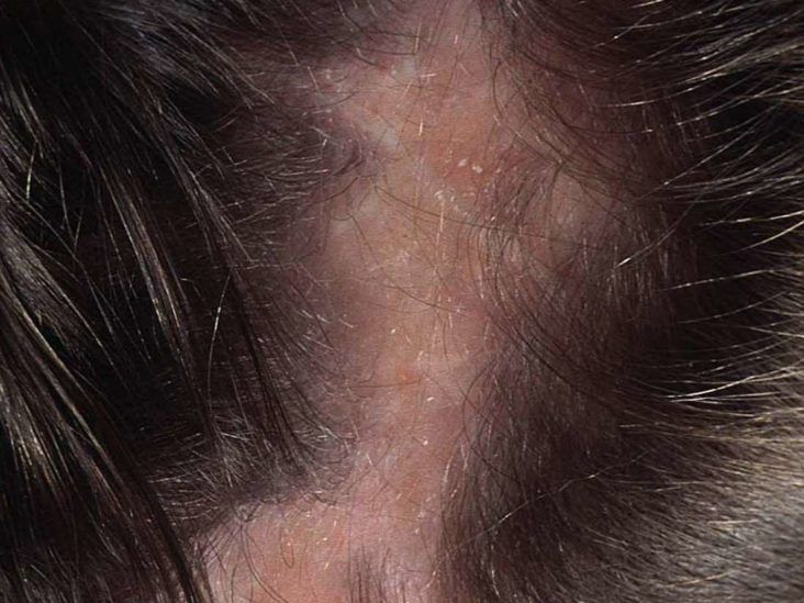 Tinea Capitis, or Yeast? Anybody have personal experience with