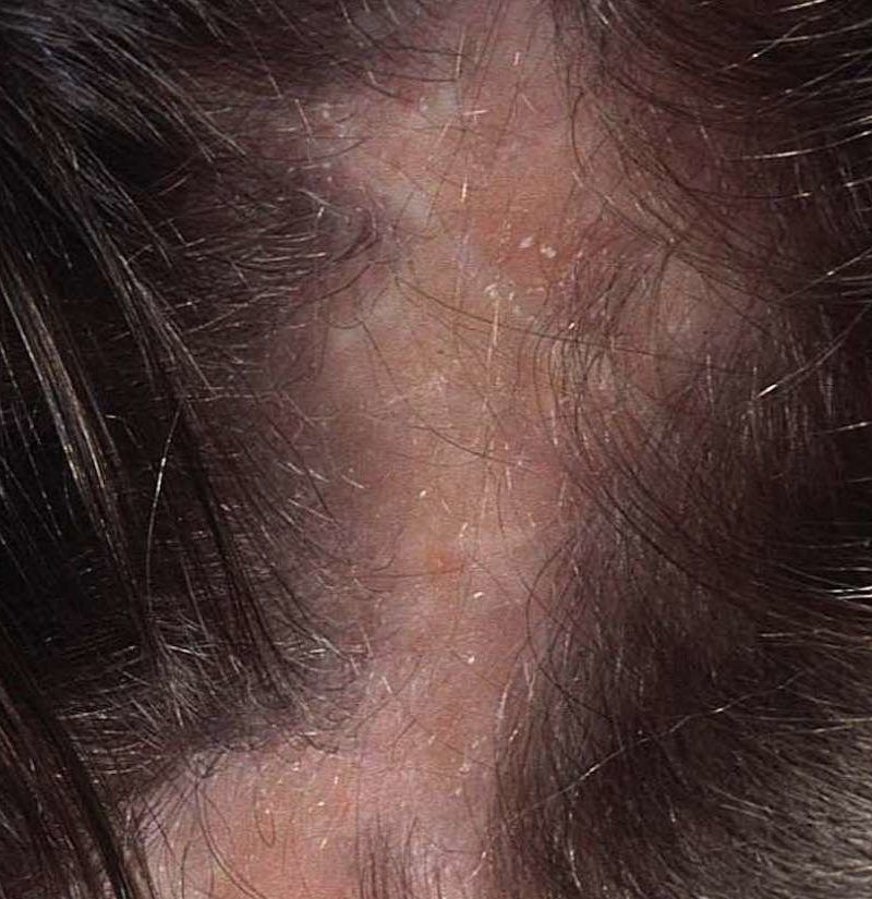Tinea Capitis, or Yeast? Anybody have personal experience with