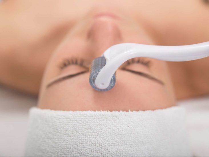 RF Microneedling