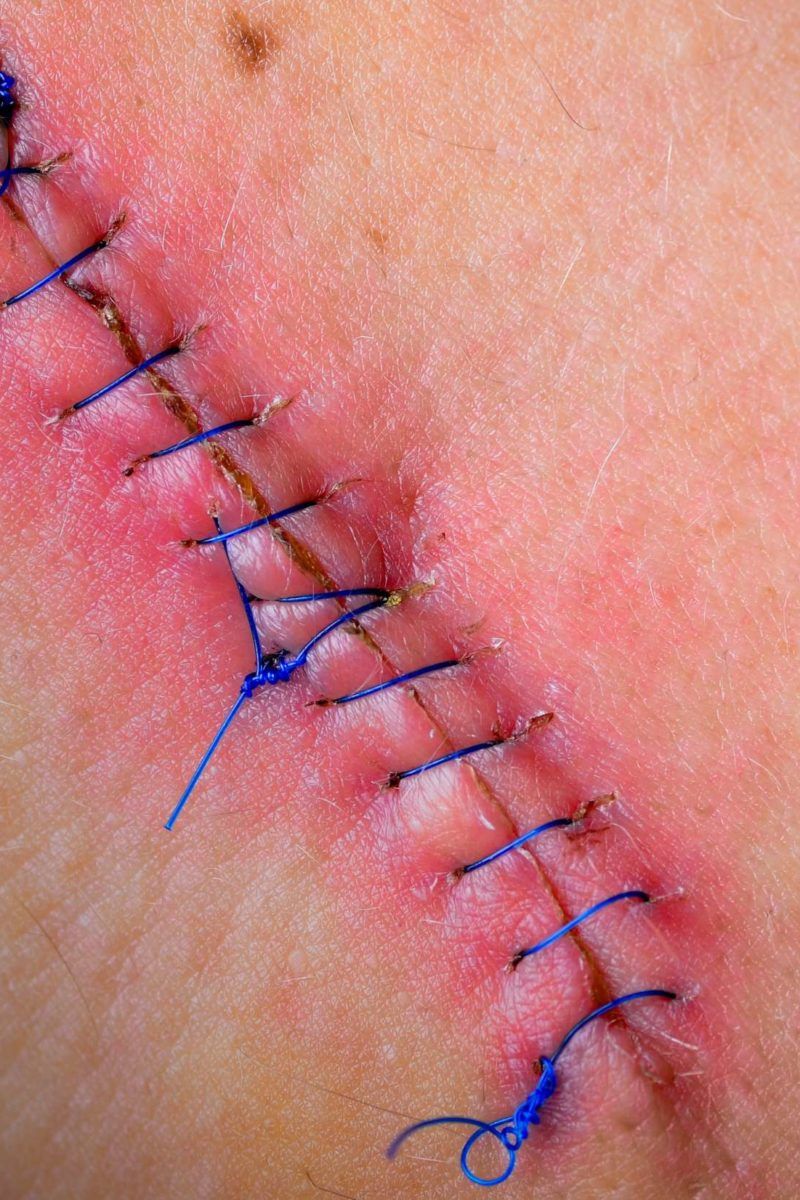 How to remove stitches safely at home