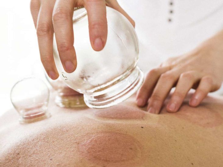 How to do Cupping Therapy at Home?