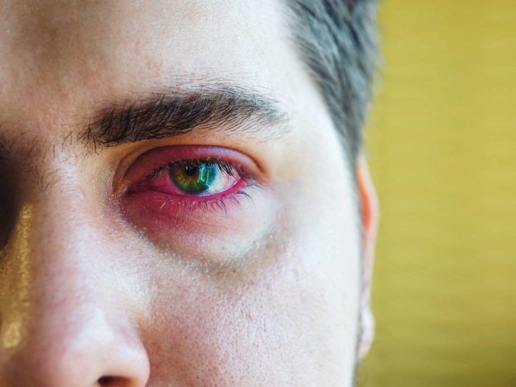 Stye (Sty): What It Is, Causes, Symptoms & Treatment