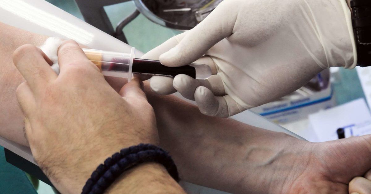 RA latex turbid test Normal range, procedure, and results