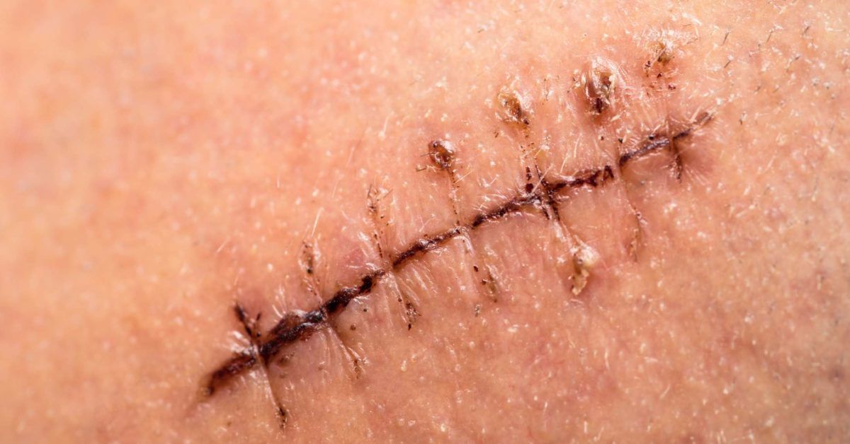 DR.TSAO'S CLINIC OF PLASTIC SURGERY Treatment of Wide Depressed Scars and  Boxcars