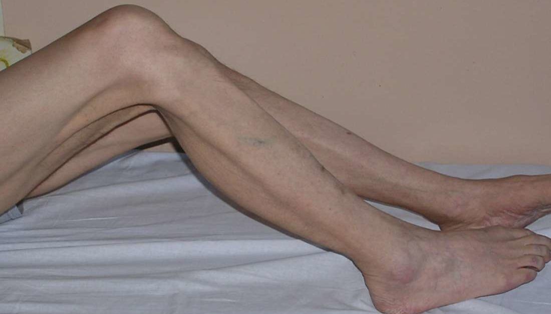 Muscle atrophy: Causes, symptoms, and treatments