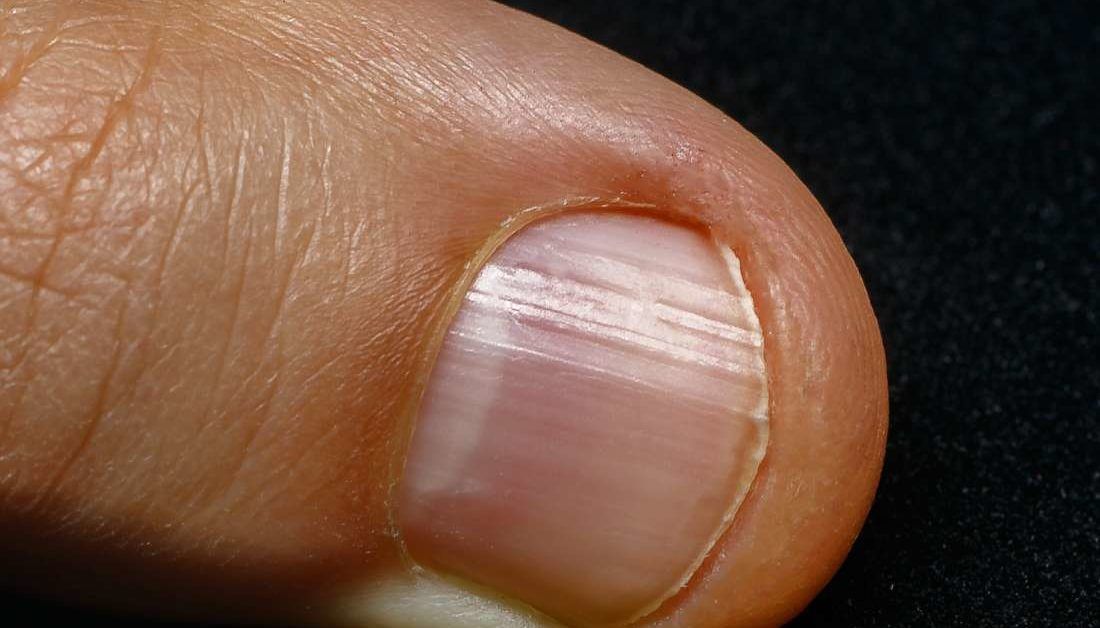 What Your Fingernails Reveal About Your Health | Newsmax.com