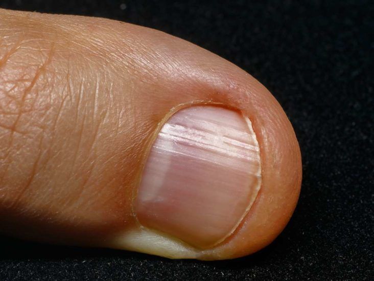 If You Have Ridges On Your Fingernails It Means This - YouTube