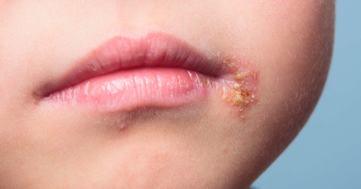 Infected blister: Symptoms, first aid, treatment, and healing