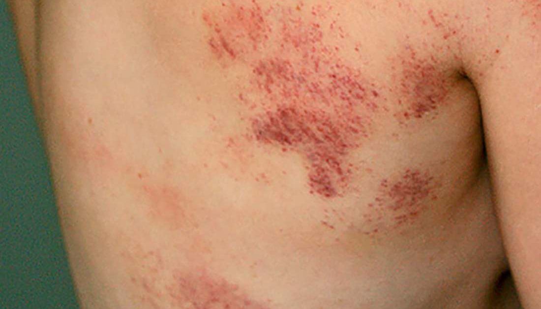 Bruise on Breast: Causes and Treatments