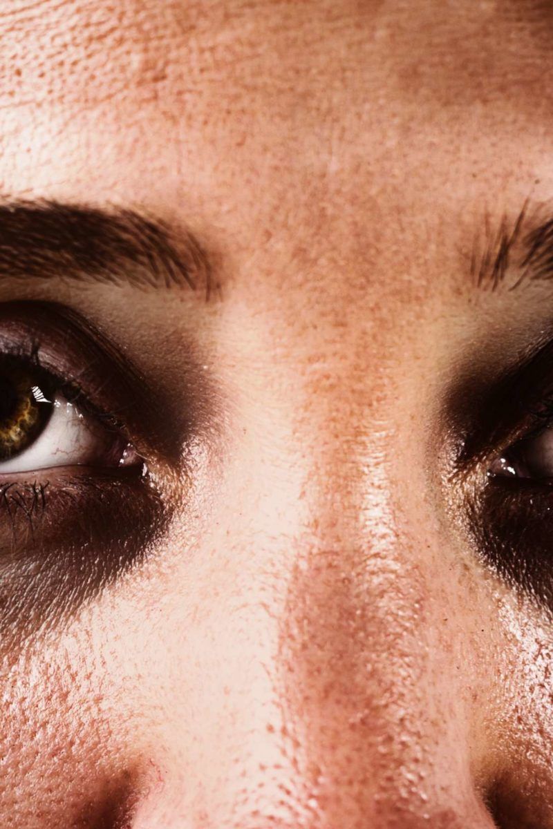 Dark circles under the eyes: Causes and treatments