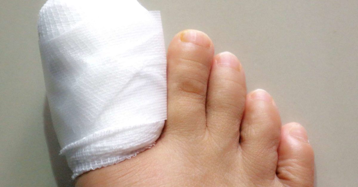 Surgery for ingrown toenails: Procedure, recovery, and risks