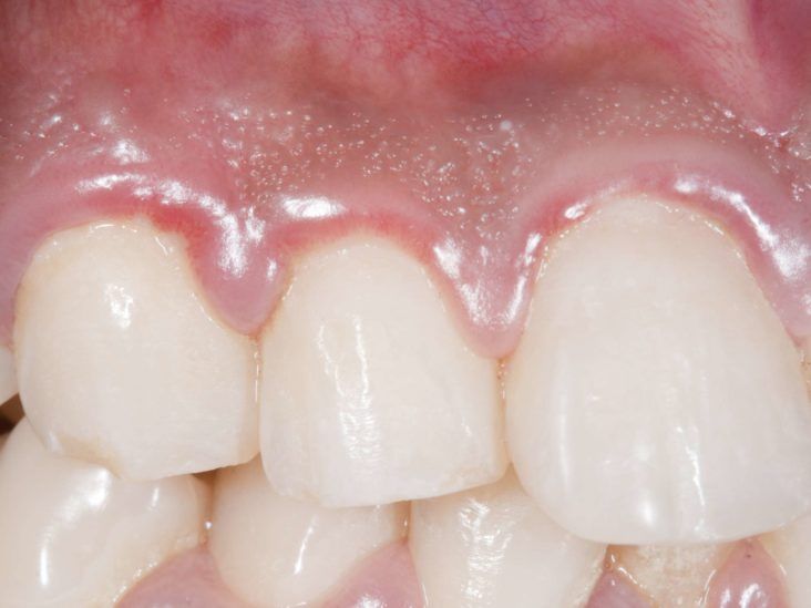 White Spots on Gums: 6 Causes and How to Treat Them