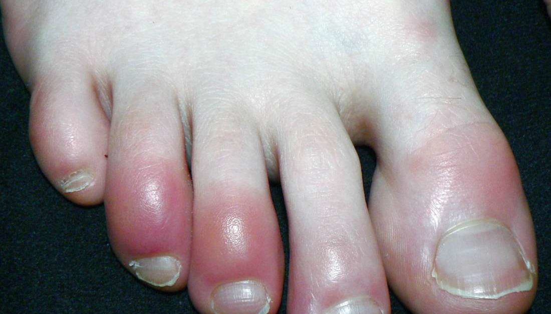 How Does Psoriatic Arthritis Affect Nails?