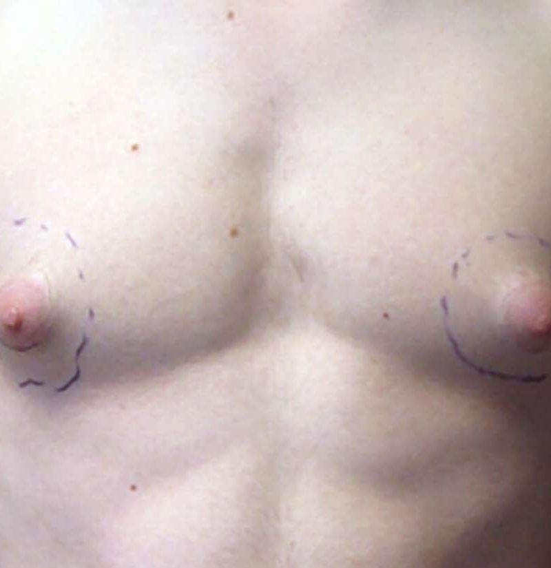 Puffy nipples in men: Remedies and causes