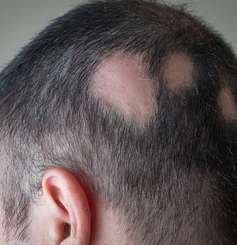Alopecia areata Symptoms treatment and tips