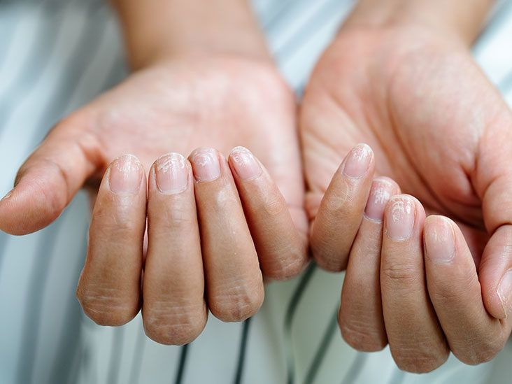 From ridges to white spots - what your nails reveal about your health and  risk of silent killers | The Sun