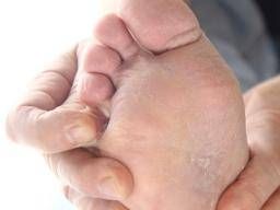 The patient's hands and feet (A) Tinea pedis on the fifth toe of