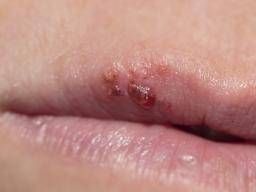 Is It Herpes of Something Else? How To Tell