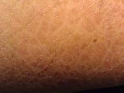 Scaly Skin  Ichthyosis Vulgaris - Skinsight