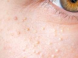 White spots on the face: Possible causes and treatments