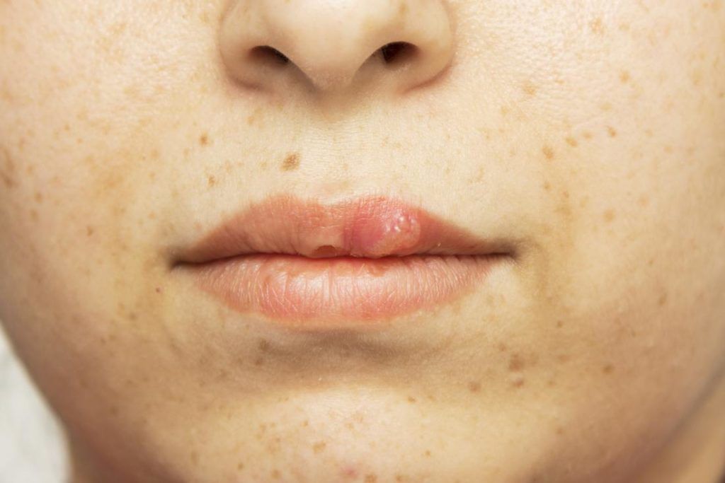 oral herpes on lips
