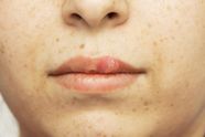 HIV related Mouth Sores Symptoms And Treatments