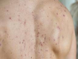 Pimples: Why do they happen?
