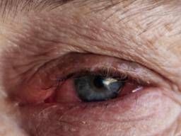 How long does pink eye last? 7 signs you are still contagious