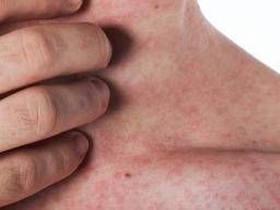 Heat rash: Symptoms, treatment, appearance, and causes