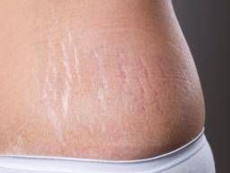 5 Ways to Prevent Stretch Marks From Working Out – Rejûvaskin