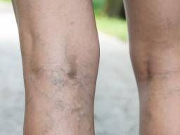 What Age is Normal for Varicose Veins?