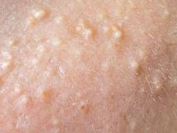 What causes sudden appearance of white round spots on legs? - Dr